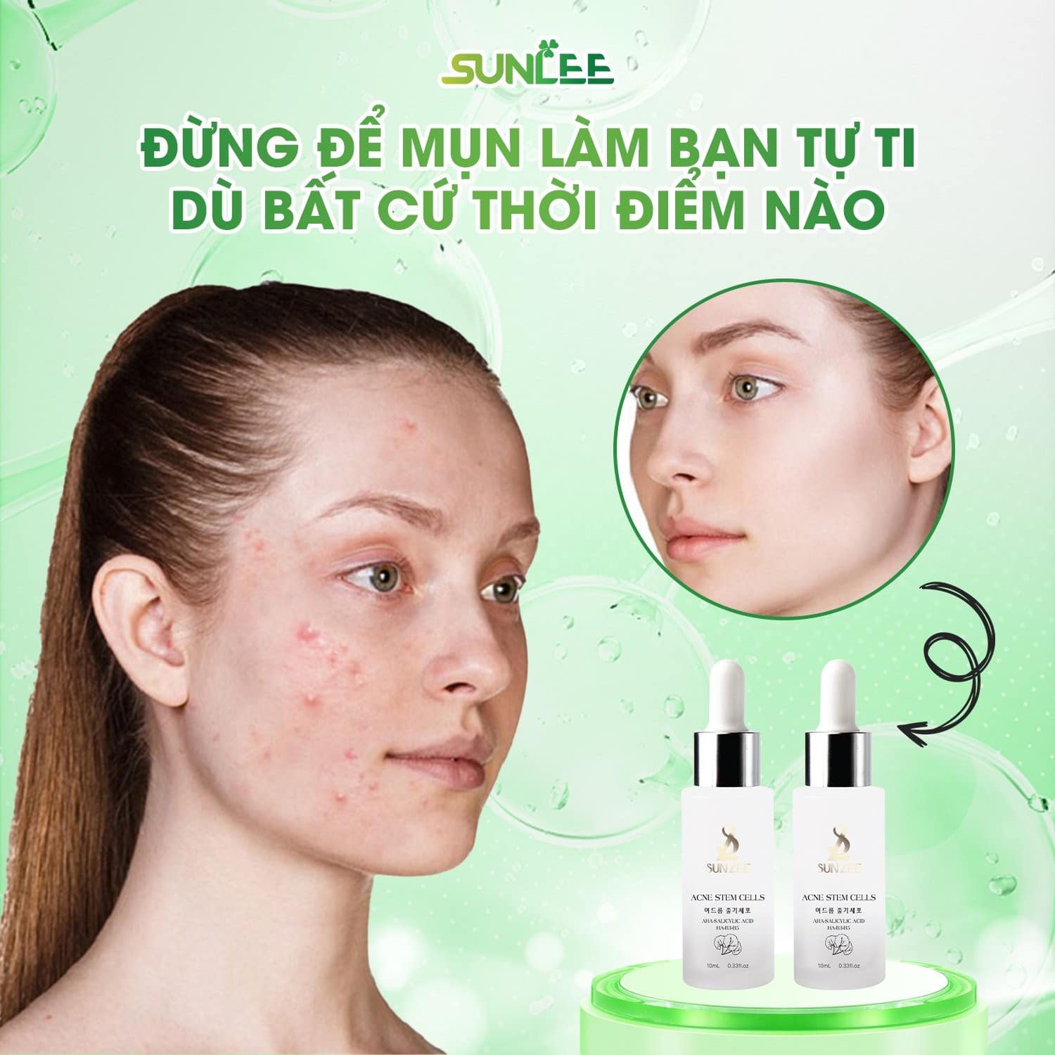 Tế bào gốc trị mụn SunLee